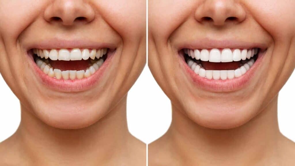 Before and after teeth whitening results. Crawley